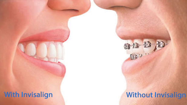Rhodes Ranch Invisalign, Invisible Braces in Rhodes Ranch