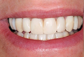 Rhodes Ranch Invisalign  Invisible Braces in Rhodes Ranch